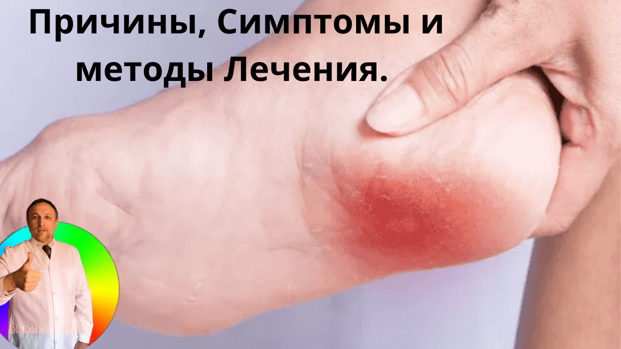 пяточная шпора
